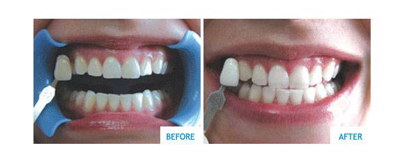 teeth whitening cost toronto